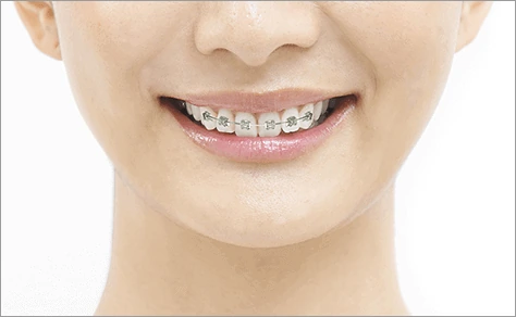 矯正歯科イメージ写真