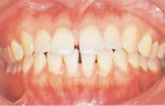 すき歯（空隙歯列弓）